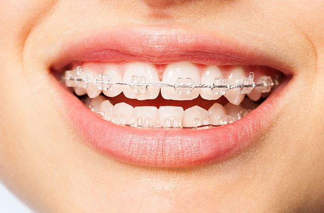 Closeup of smile with clear and ceramic braces