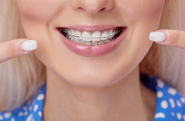 a close-up of a patient with clear braces