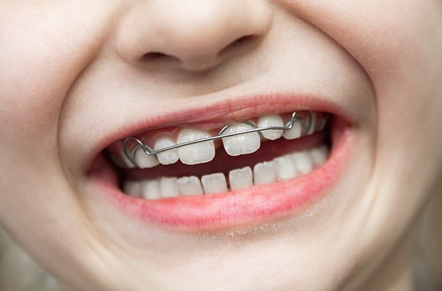 Closeup of young patient receiving dentofacial orthopedic treatment