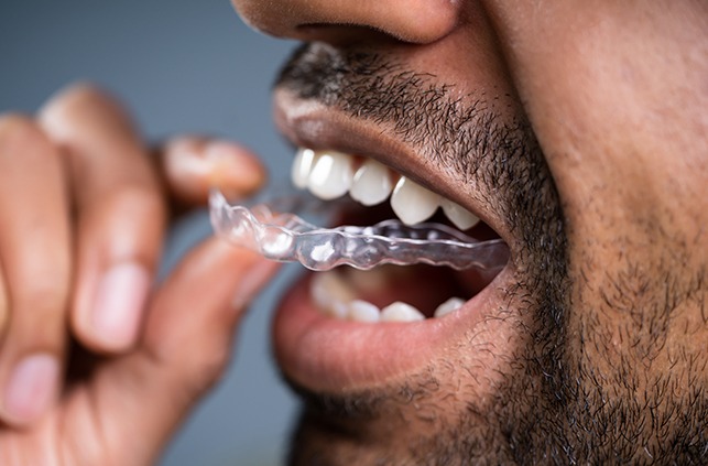 Closeup of man placing an Invisalign tray