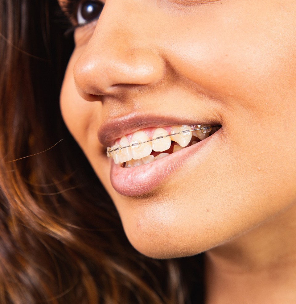 Woman smiling with braces after visiting a MetLife orthodontist in Worcester