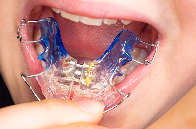 Patient placing orthodontic appliance for pediatric orthodontic treatment