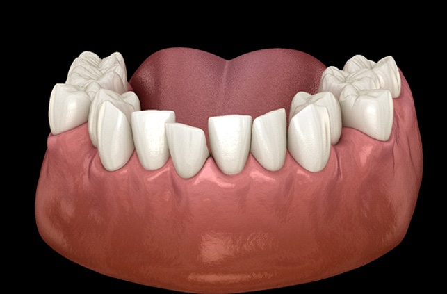 Diagram of overcrowded teeth in Worcester before braces