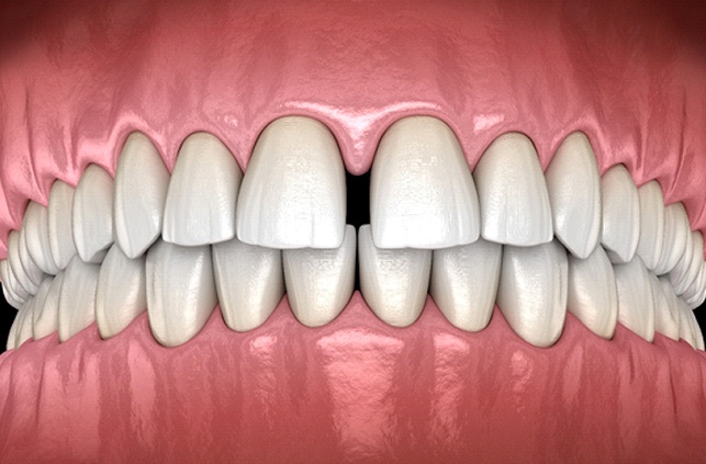 Diagram of gapped teeth in Worcester before orthodontics