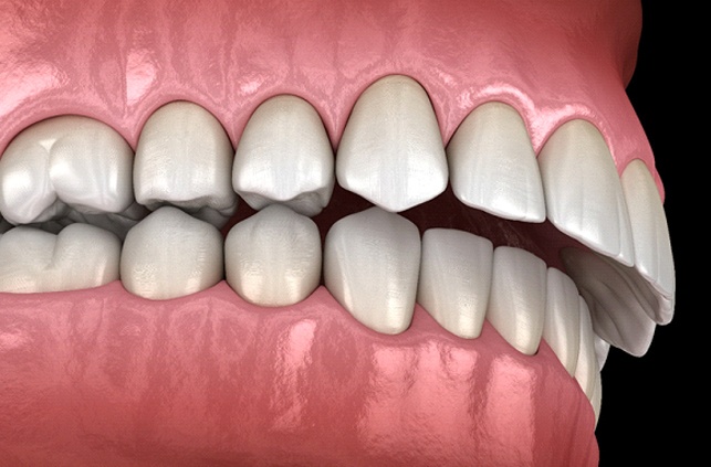 Diagram of overbite in Worcester before braces in Worcester