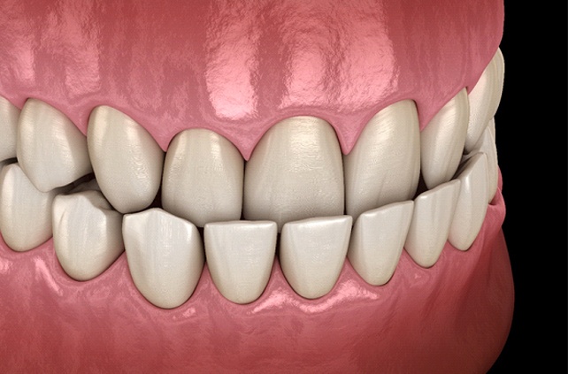 Diagram of underbite in Worcester before braces in Worcester