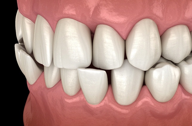 Diagram of crossbite in Worcester before braces in Worcester