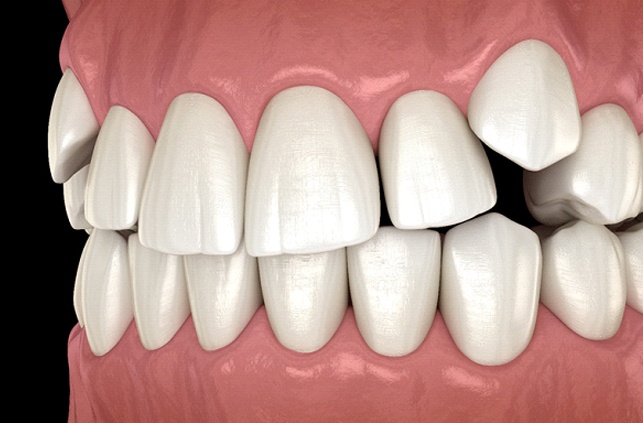 Diagram of impacted canines in Worcester before braces in Worcester