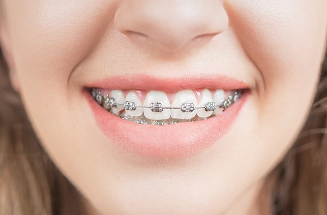 Closeup of smile with self-ligating braces