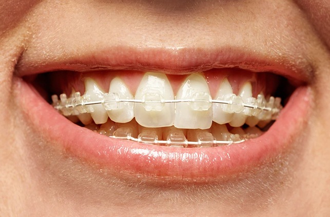 Closeup of smile clear braces