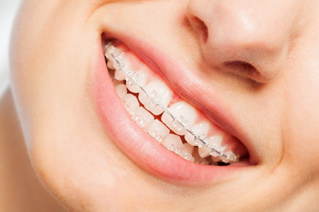 Closeup of woman smiling with braces