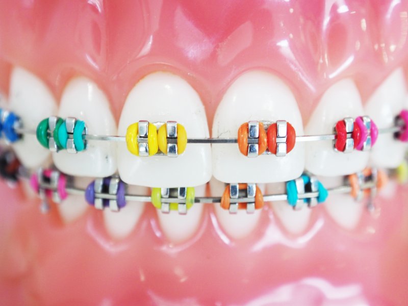 Braces Elastics / Rubber Bands – 5 Most Common Questions 