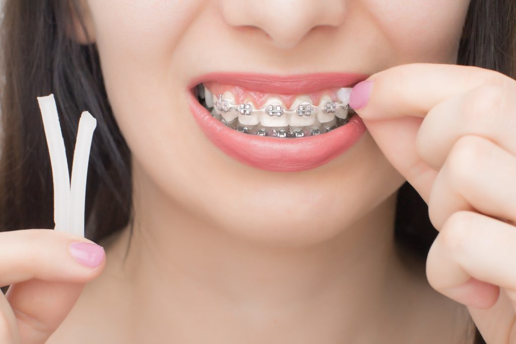 Closeup of woman placing dental wax over the sharp edge of her braces