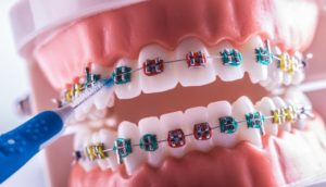 model of braces in Worcester