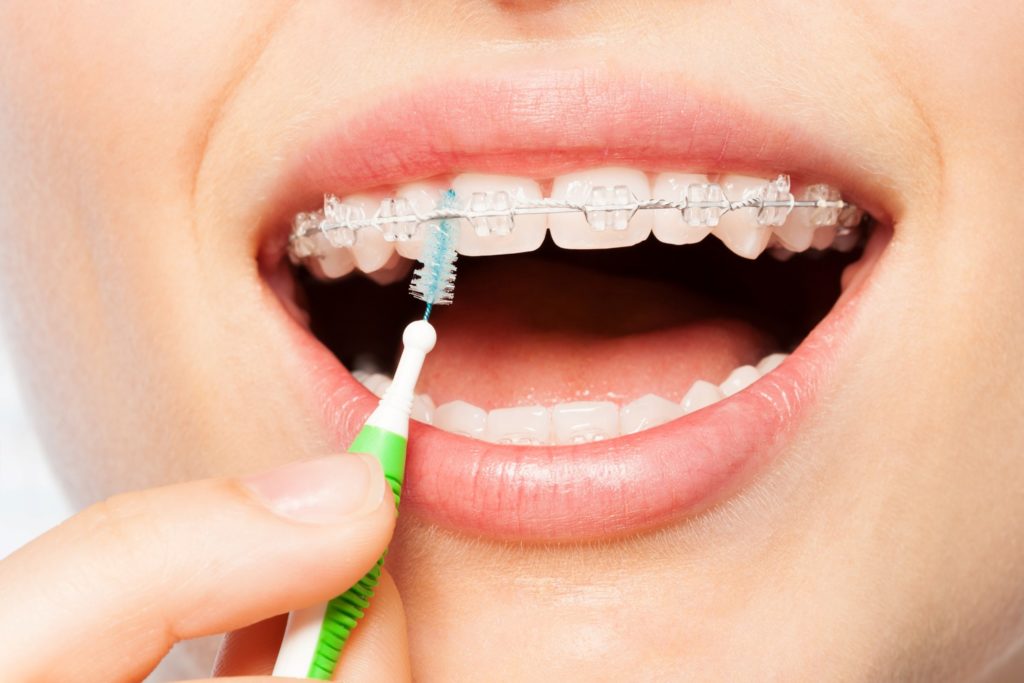 Woman with braces smiling while using interproximal toothbrush