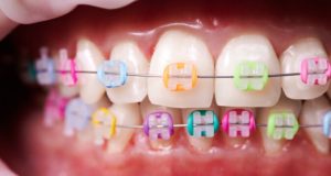 a closeup of braces with rubber bands